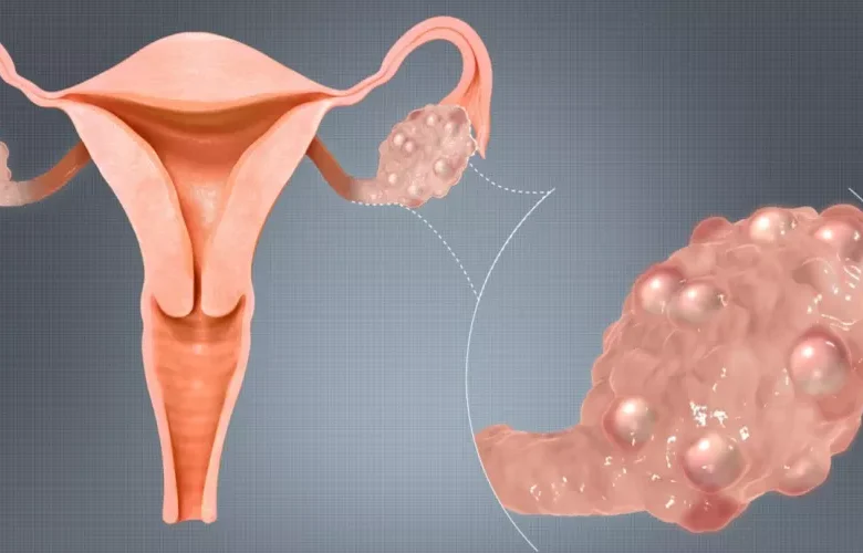 تمزقات أكياس المبيض لدى النساء