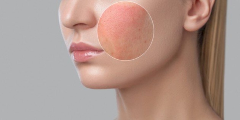 تهدئة تهيجات البشرة وتقليل الالتهابات