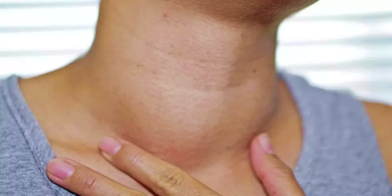 تورم الغدد اللمفاوية