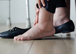 حالات مرضية تؤدي إلى تورم القدمين