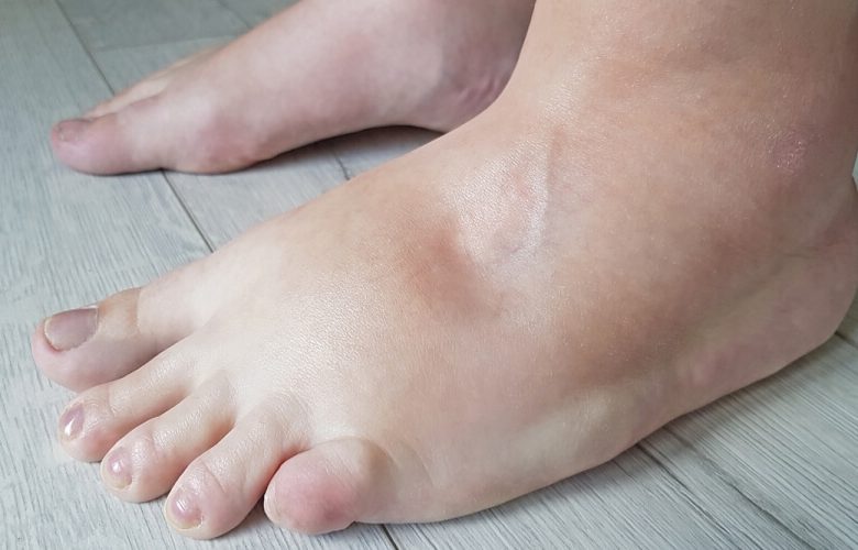 حالات مرضية تؤدي إلى تورم القدمين