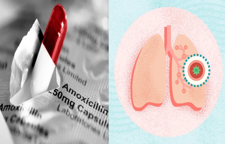 دور المضادات الحيوية في علاج التهاب الشعب الهوائية الحاد