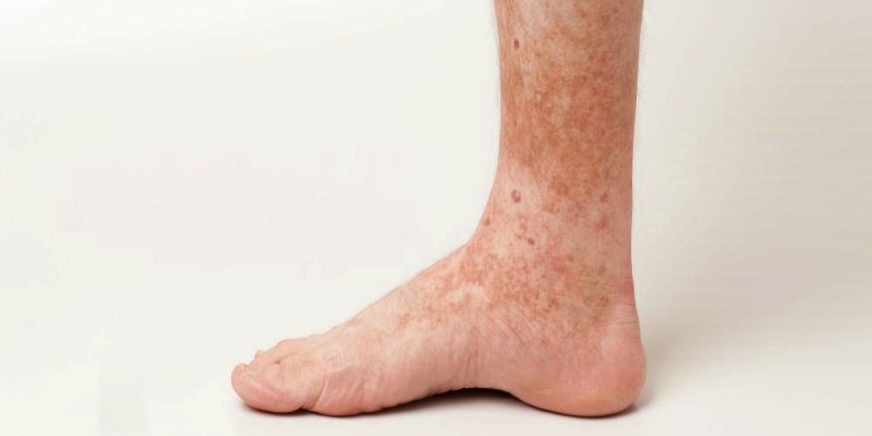 ظهور البقع البنية أسفل الساقين