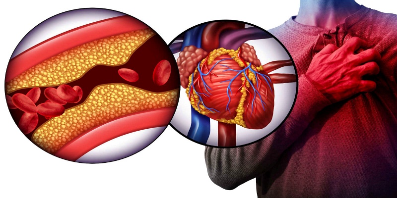 عوامل تؤدي إلى الإضرار بصحة الأوعية الدموية يجب الابتعاد عنها