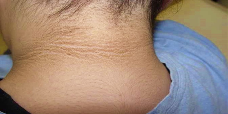 غمقان الجلد في الرقبة والإبطين