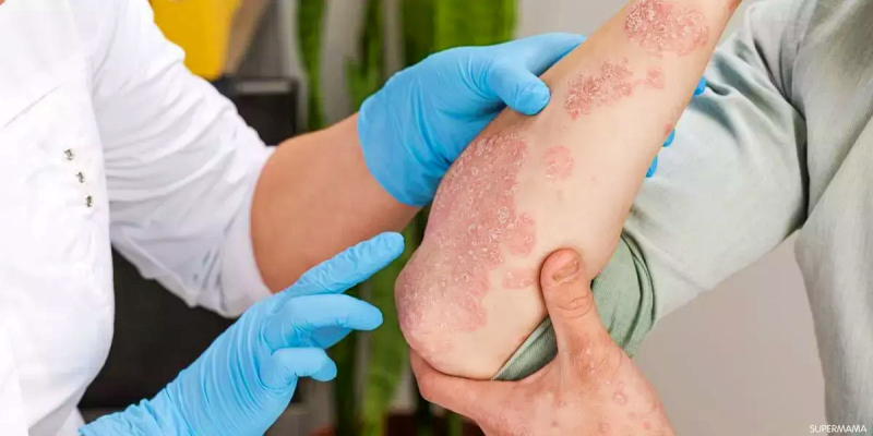 كيفية&nbsp;الوقاية من تكرار الإصابة بمرض الإكزيما