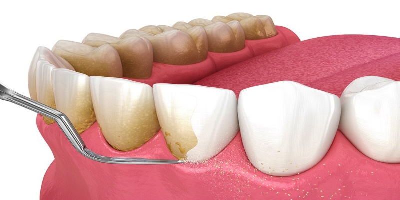 ما أهمية إزالة الجير بشكل دوري؟