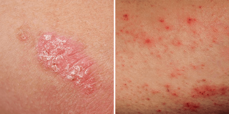 ما المقصود بالإكزيما الجلدية؟