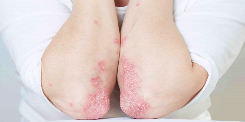 ما هي أسباب الإصابة بمرض بالإكزيما الجلدى؟