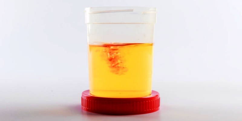 ما هي أنواع البول الدموي؟