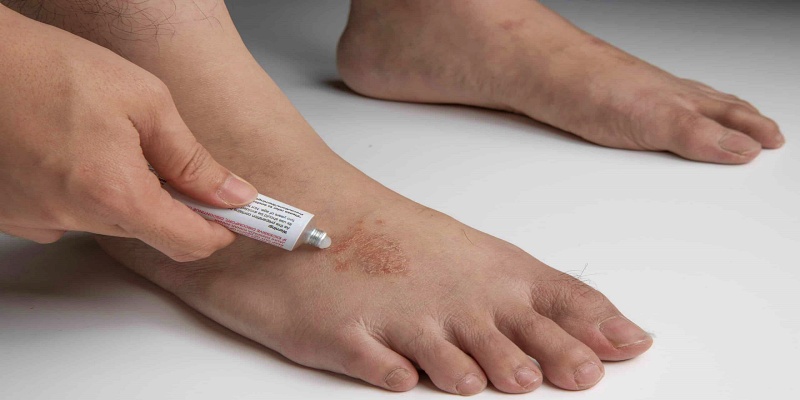 ما هي أهم التحذيرات حول سوء استخدام الأدوية المعنية بعلاج فطريات الجلد؟