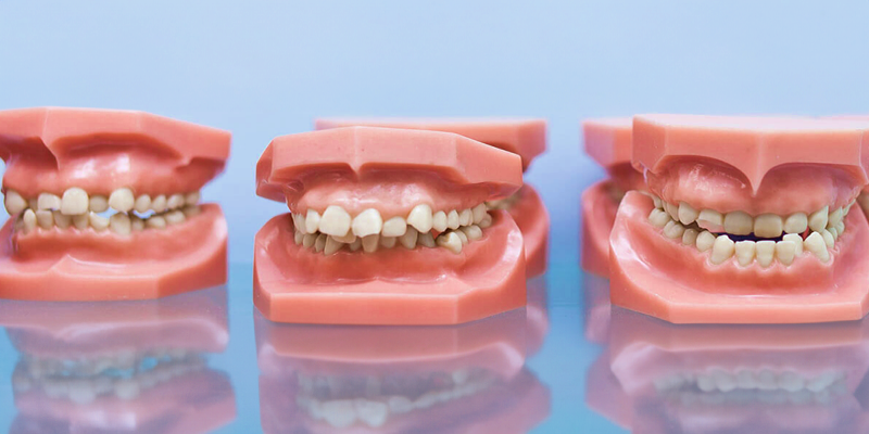 ما هي أهم التصنيفات الشائعة لأزمة سوء الإطباق؟