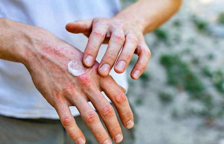 ما هي المعايير الصحيحة لاختيار أفضل مرطب لالتهاب الجلد التأتبي؟