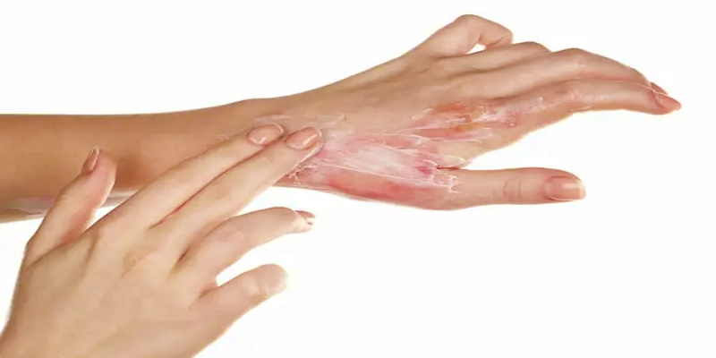 مبادئ هامة للسيطرة على مرض الإكزيما الجلدي