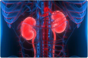  متلازمة الكلى النفروزية