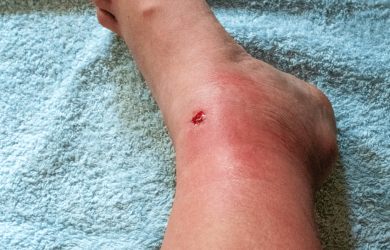 مخاطر الإصابة بالعدوى الدموية الناتجة عن الجروح الطفيفة