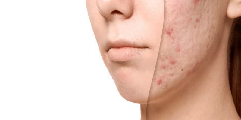 هل يمكن أن تمتلئ الندوب المثقوبة من تلقاء نفسها؟