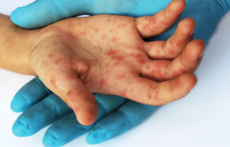 5 أدوية يجب على الأطفال تناولها عند المعاناة من أمراض اليد والقدم والفم