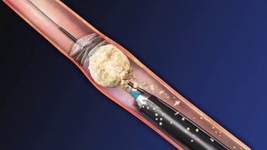 أشعة الليزر لتفتيت الحصوات