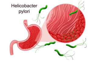 أعراض جرثومة المعدة