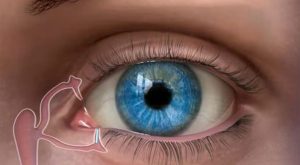 أنواع سدادات القناة الدمعية