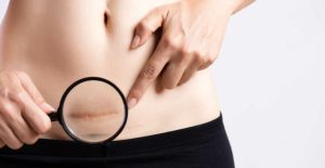 أنواع ندبات الولادة القيصرية