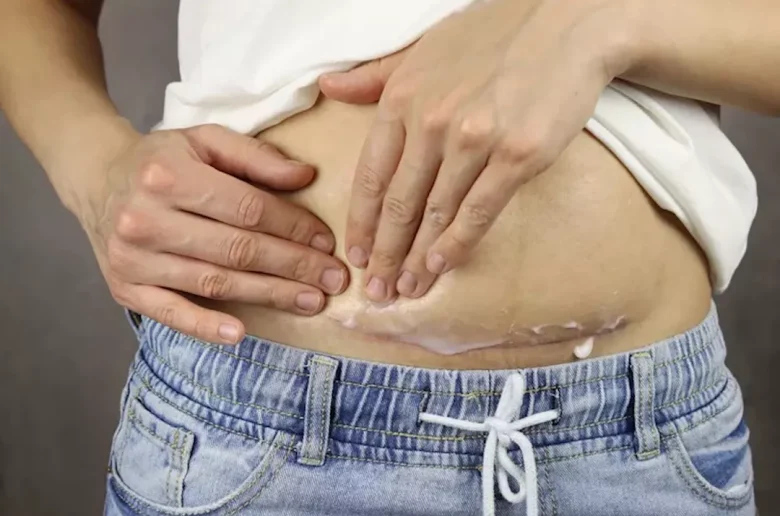 أهمية تدليك مابعد الولادة القيصرية