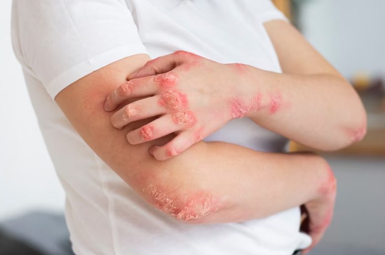 أهمية فيتامين e كجزء من علاج مرض الصدفية