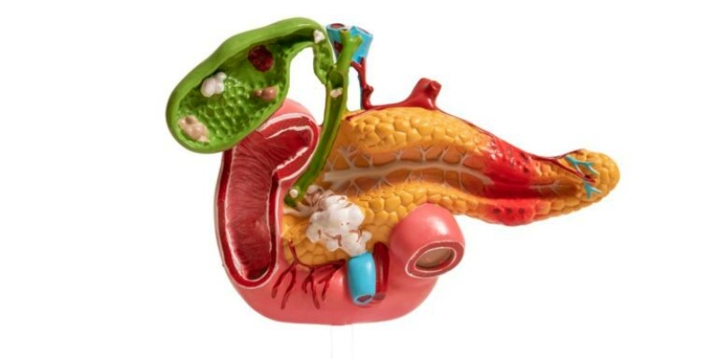 أورام رأس البنكرياس&nbsp;