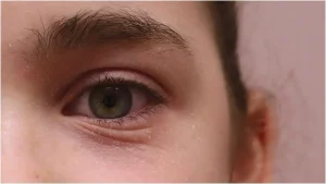 إكزيما الجفون