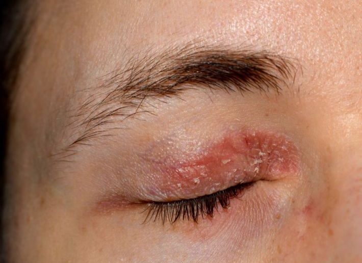 إكزيما الجفون