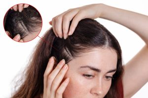 إكزيما فروة الرأس