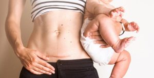 إلى أي مدى  يكون تدليك ندبة الجراحة القيصرية مفيدا ؟