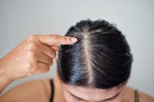 الأسباب المحتملة لإكزيما فروة الرأس