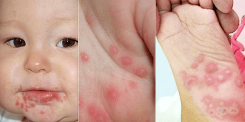 الأطفال المصابون بأمراض اليد والقدم والفم والتغذية الجيدة