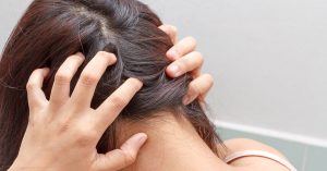 الأعراض الشائعة لإكزيما فروة الرأس