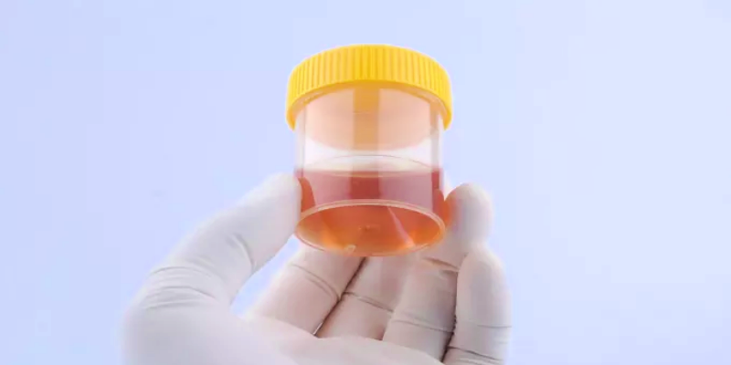 التغيرات الغير طبيعية في لون البول والجلد