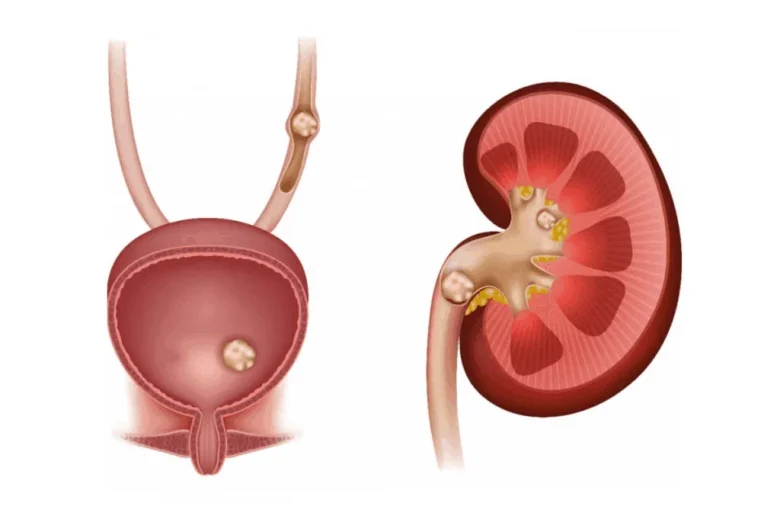 الحصوات الكلوية العالقة في المثانة