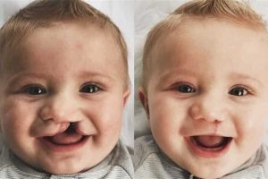 الخيارات العلاجية للشفة الأرنبية