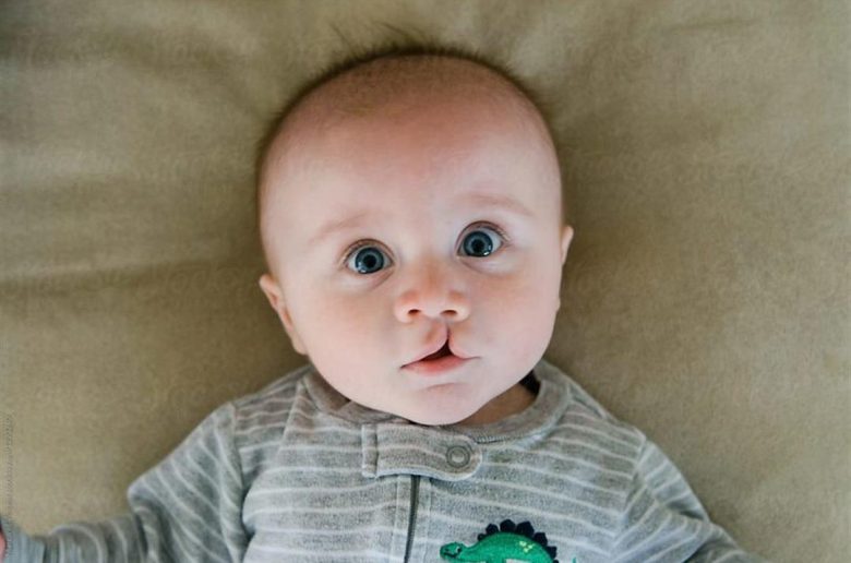 الشفة الأرنبية لدى حديثي الولادة