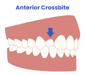 العضة المعكوسة الأمامية