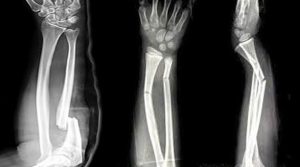 العظم الزجاجي لدى الأطفال