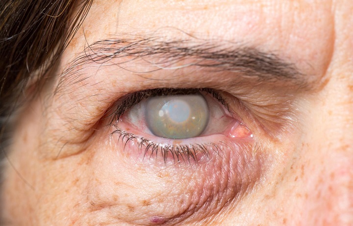 المياة البيضاء المتحجرة على العين