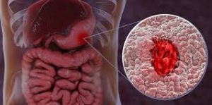 النزيف المعوي