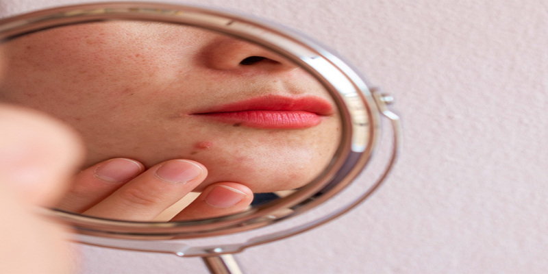 انسداد المسام