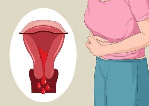 تدفق نزيف الحيض الغزير