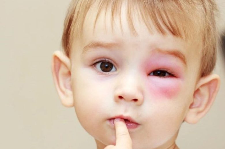 تورم الجفون عند الأطفال