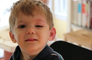 تورم الجفون عند الأطفال