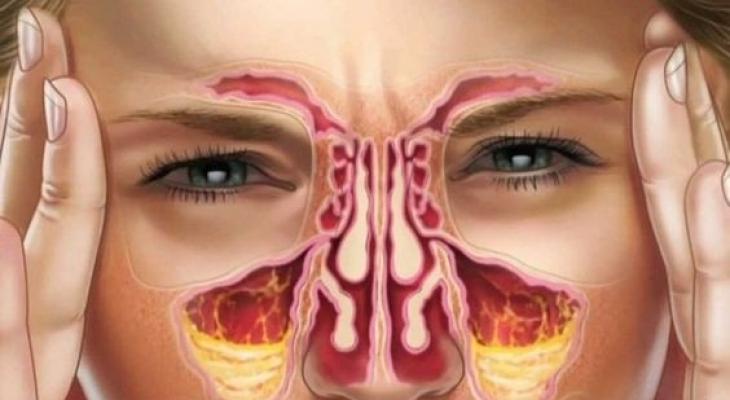 حالات صحية تؤدي لتكون الزوائد الأنفية