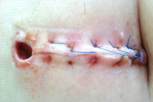 حالات يتم فيها تجنب تدليك ندبة العملية القيصرية